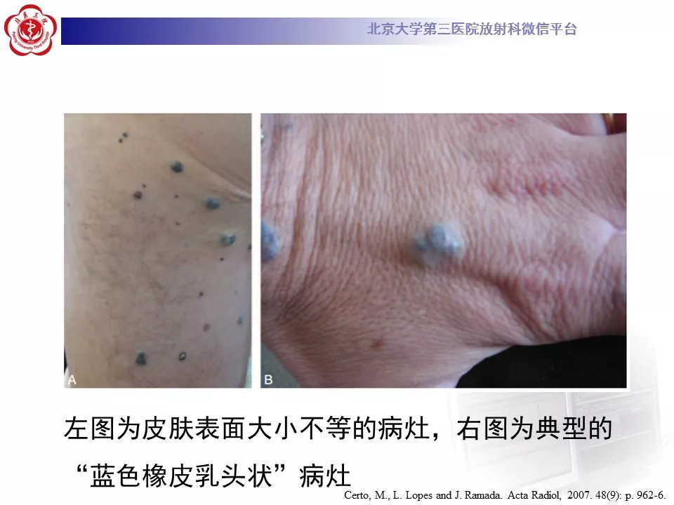 【病例】蓝色橡皮大疱样痣综合征1例CT及MR
