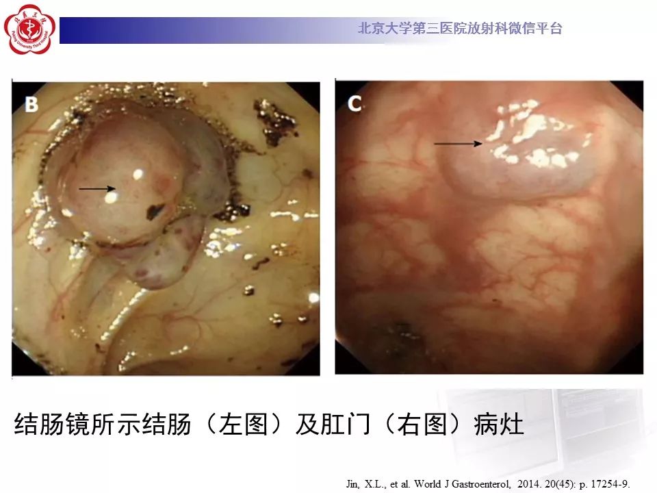 【病例】蓝色橡皮大疱样痣综合征1例CT及MR