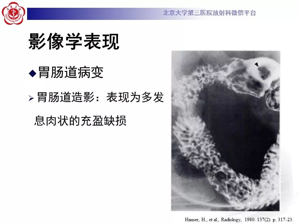 【病例】蓝色橡皮大疱样痣综合征1例CT及MR