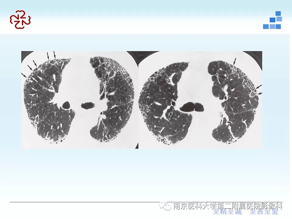 【PPT】特发性间质性肺炎CT表现