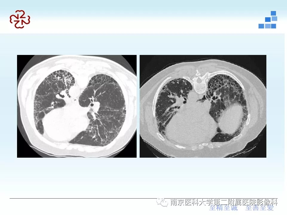 【PPT】特发性间质性肺炎CT表现