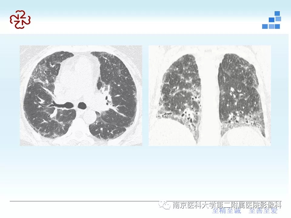 【PPT】特发性间质性肺炎CT表现