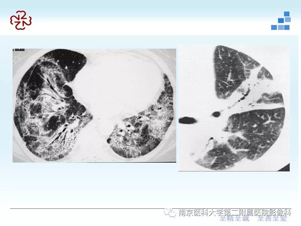 【PPT】特发性间质性肺炎CT表现
