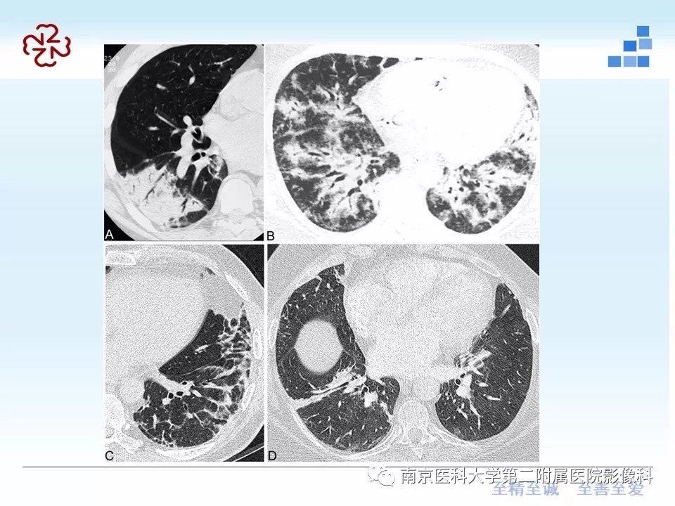 【PPT】特发性间质性肺炎CT表现