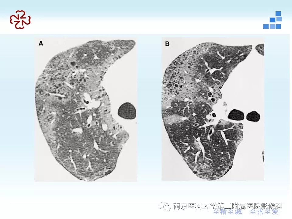 【PPT】特发性间质性肺炎CT表现