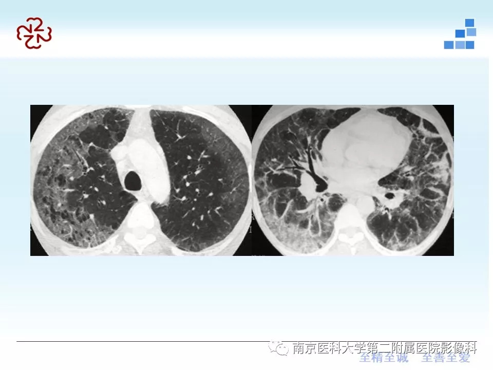 【PPT】特发性间质性肺炎CT表现
