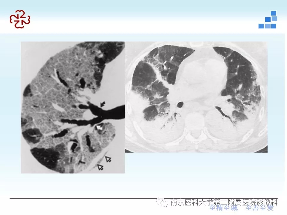 【PPT】特发性间质性肺炎CT表现