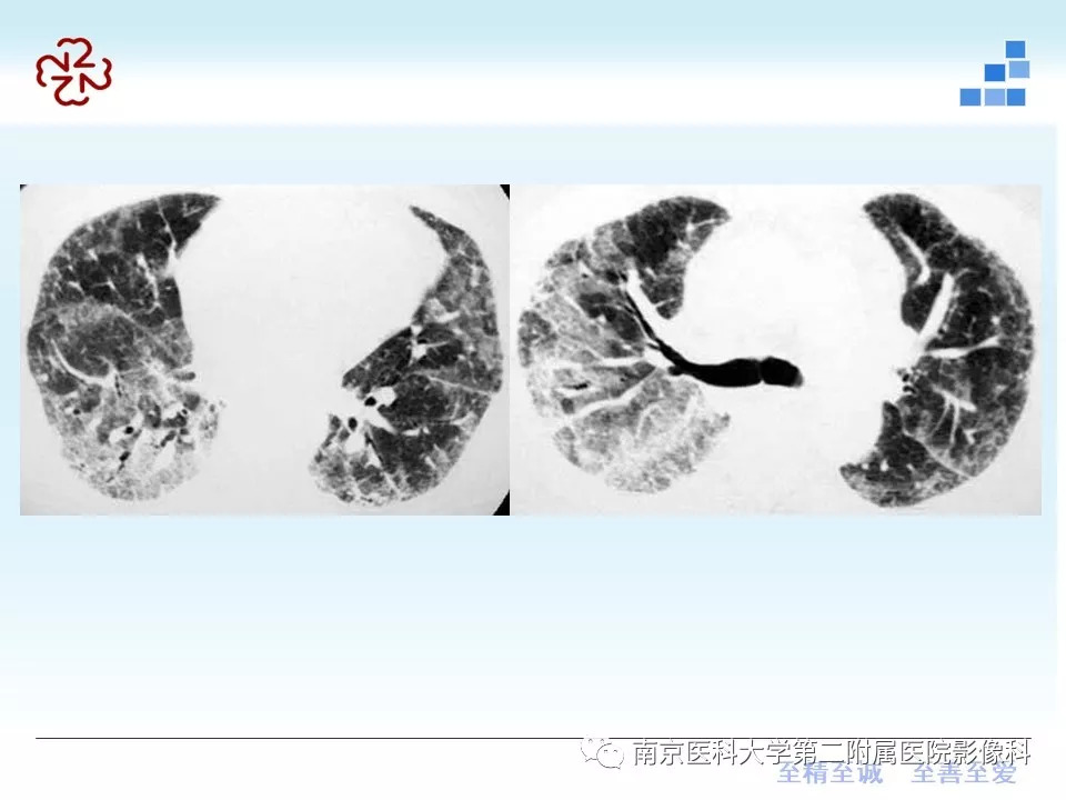 【PPT】特发性间质性肺炎CT表现