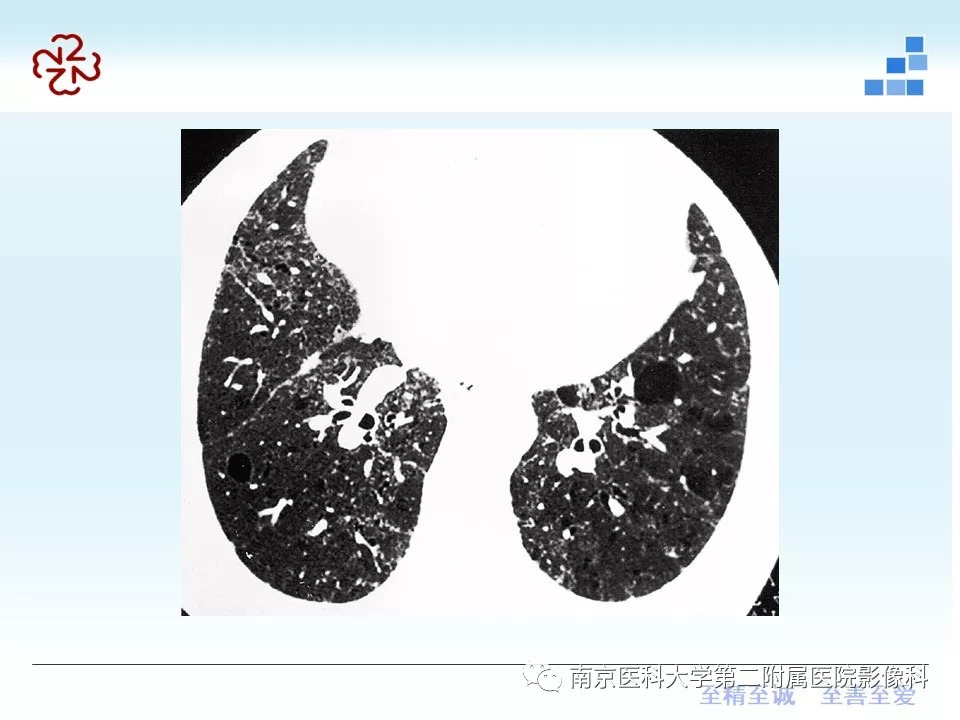 【PPT】特发性间质性肺炎CT表现