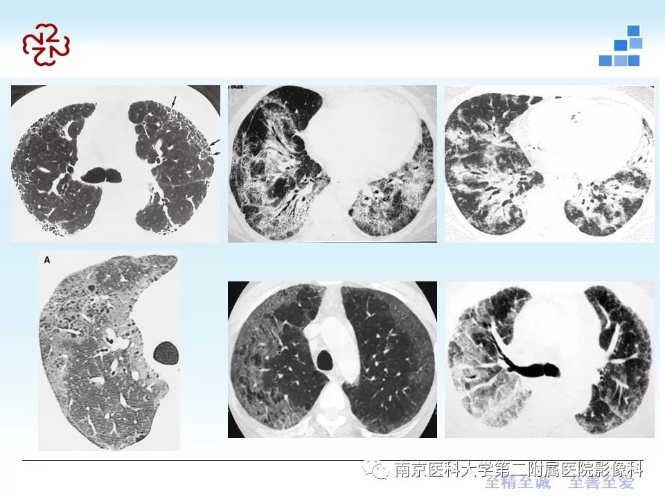 【PPT】特发性间质性肺炎CT表现
