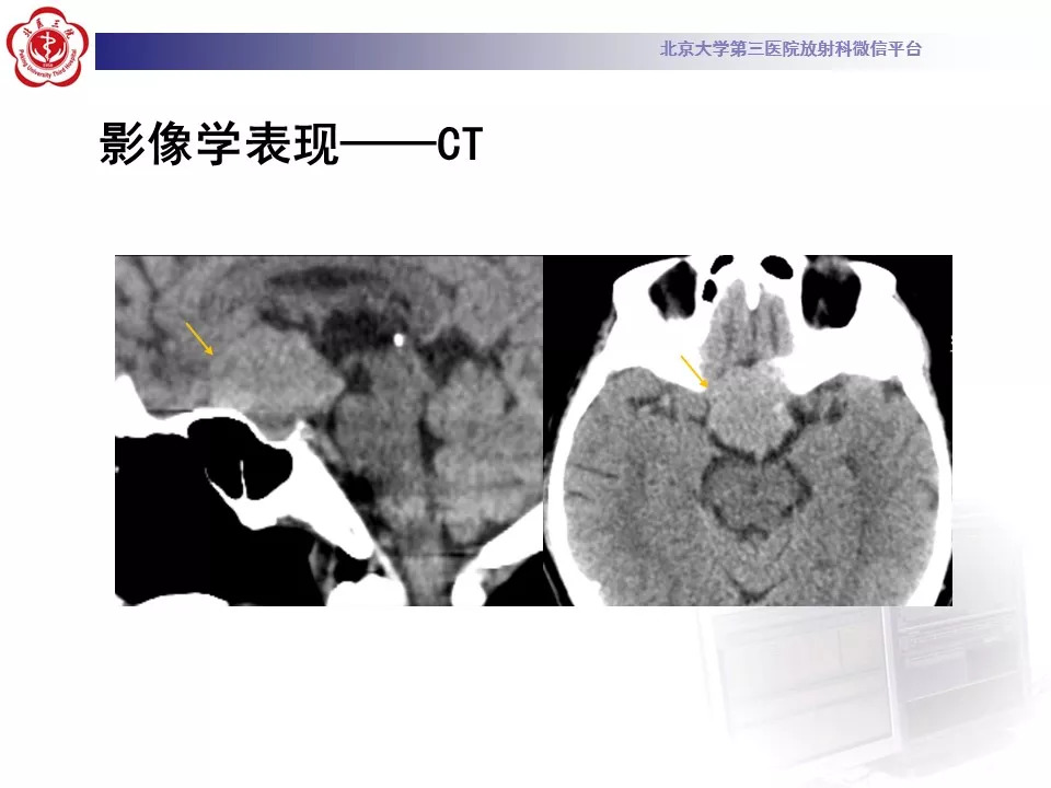 【病例】鞍区脑膜瘤1例CT及MR影像