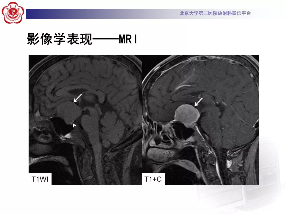 【病例】鞍区脑膜瘤1例CT及MR影像