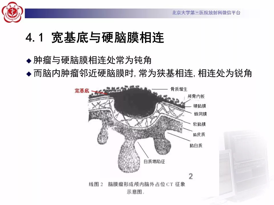 【病例】鞍区脑膜瘤1例CT及MR影像