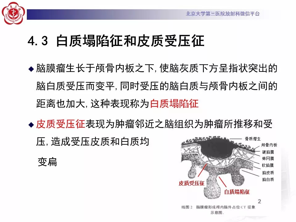 【病例】鞍区脑膜瘤1例CT及MR影像