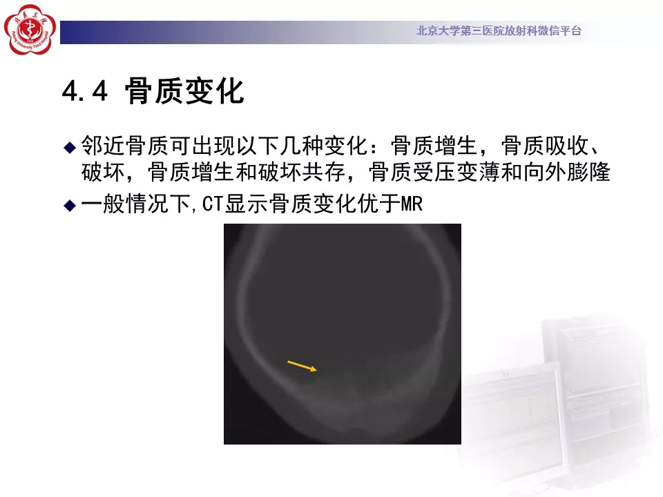 【病例】鞍区脑膜瘤1例CT及MR影像