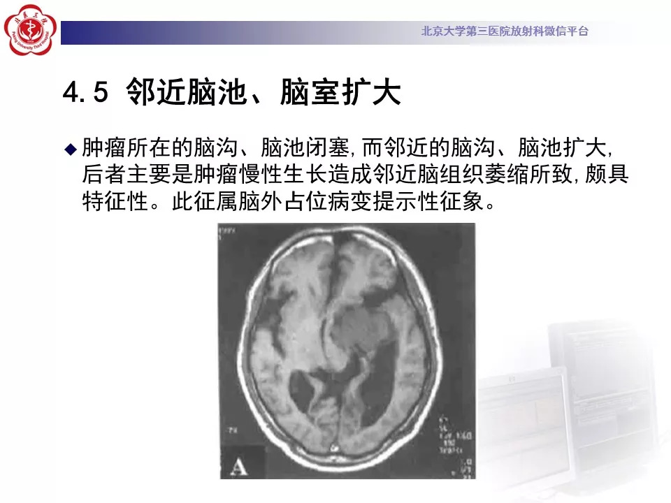 【病例】鞍区脑膜瘤1例CT及MR影像
