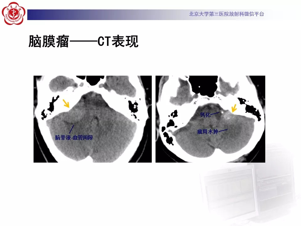 【病例】鞍区脑膜瘤1例CT及MR影像