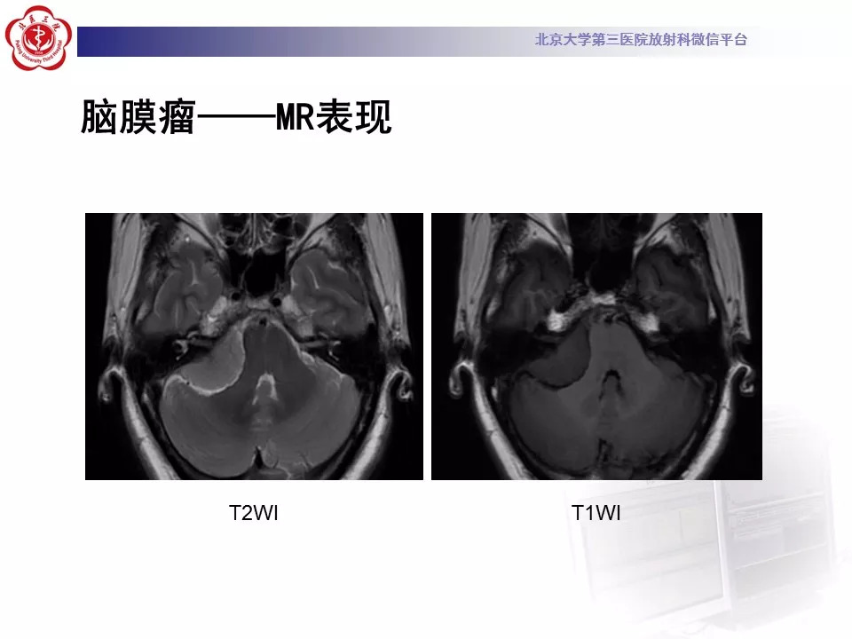 【病例】鞍区脑膜瘤1例CT及MR影像