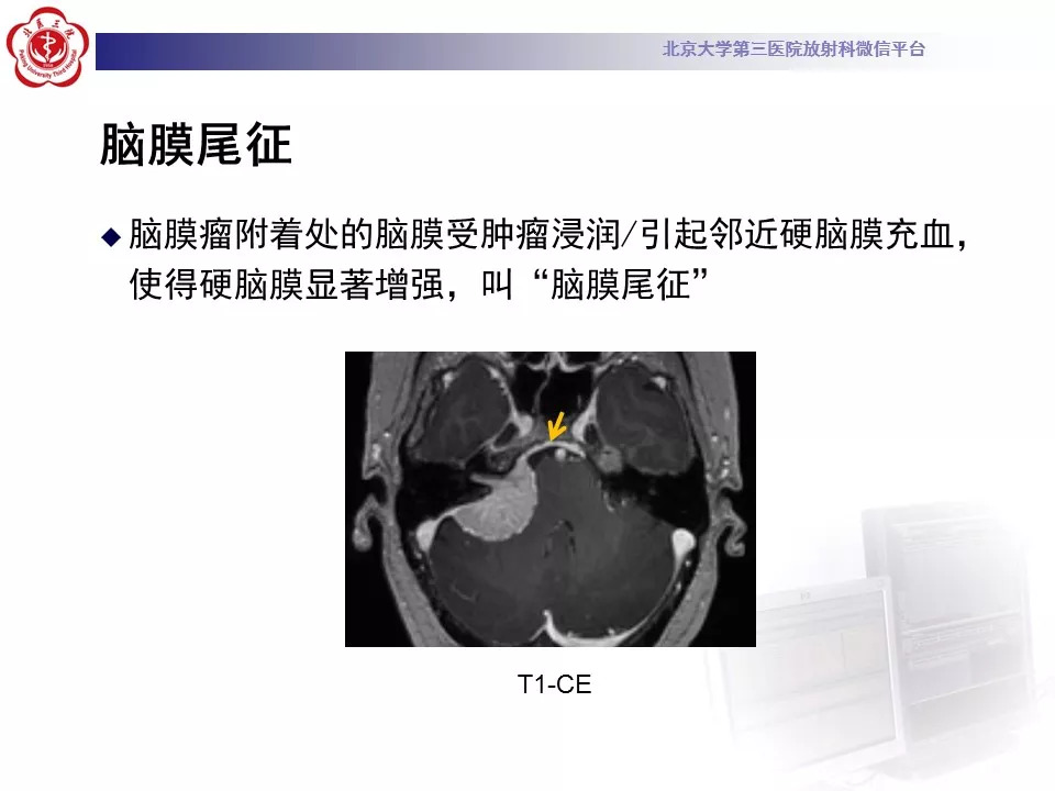 【病例】鞍区脑膜瘤1例CT及MR影像