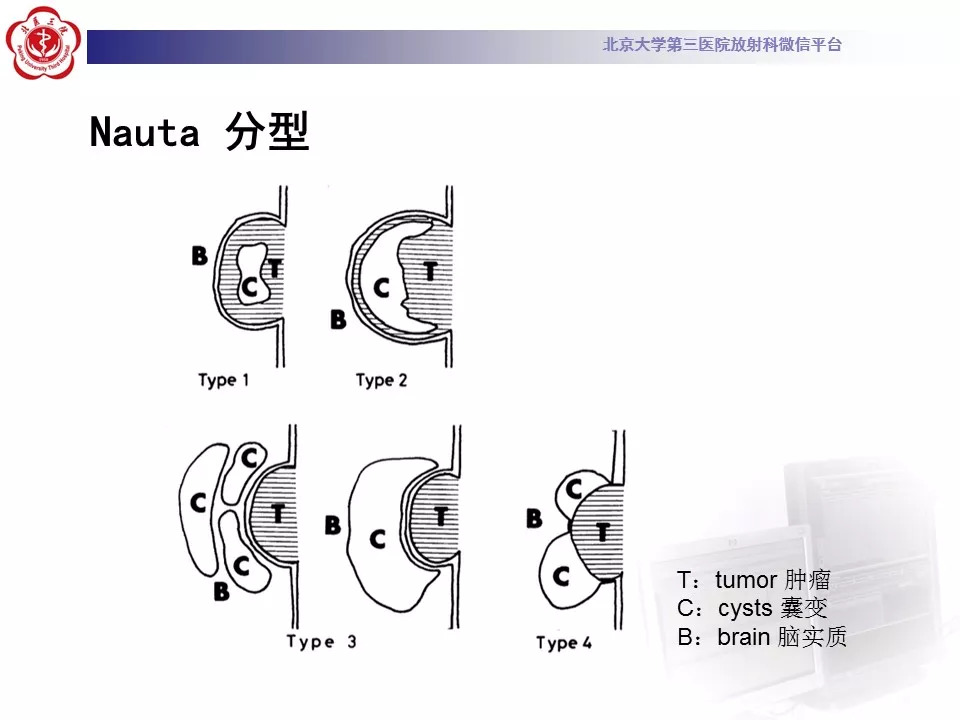 【病例】鞍区脑膜瘤1例CT及MR影像