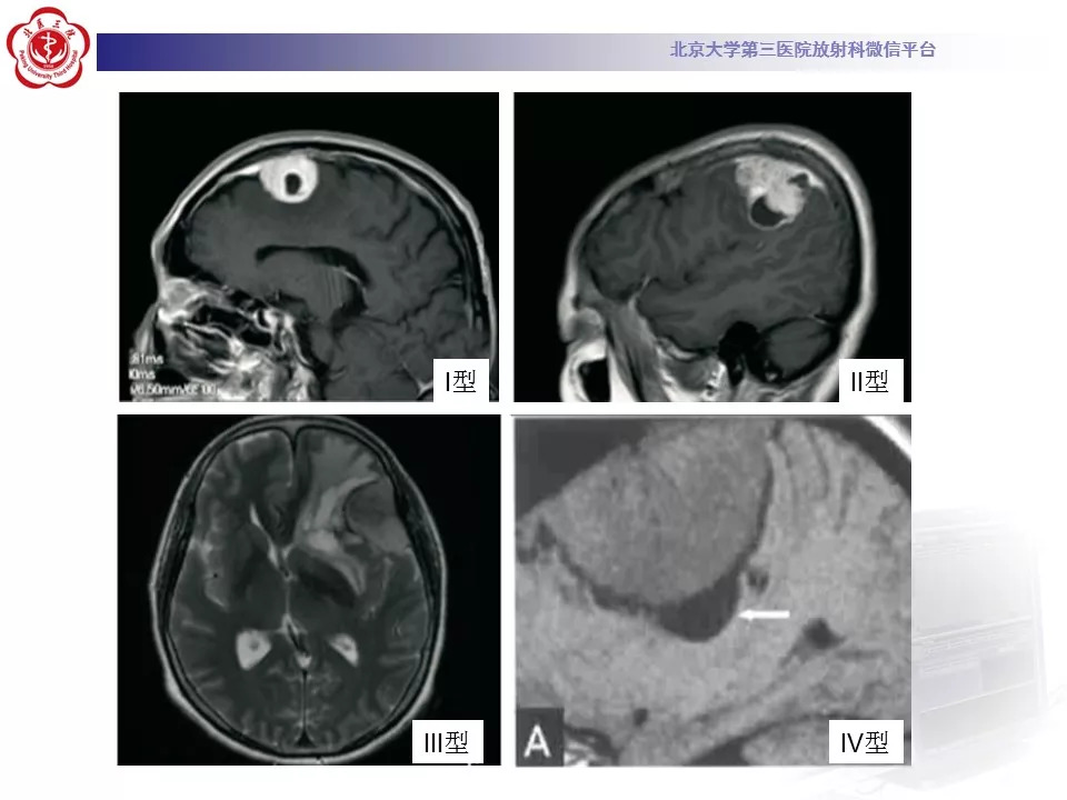 【病例】鞍区脑膜瘤1例CT及MR影像