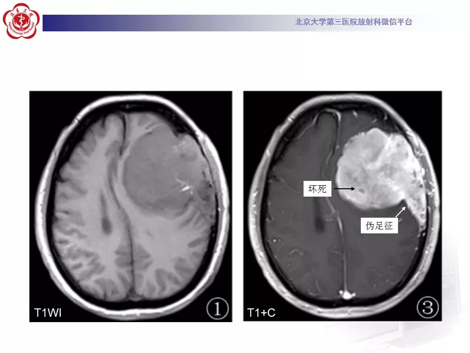 【病例】鞍区脑膜瘤1例CT及MR影像