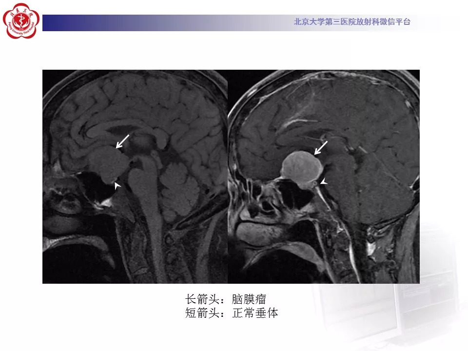 【病例】鞍区脑膜瘤1例CT及MR影像