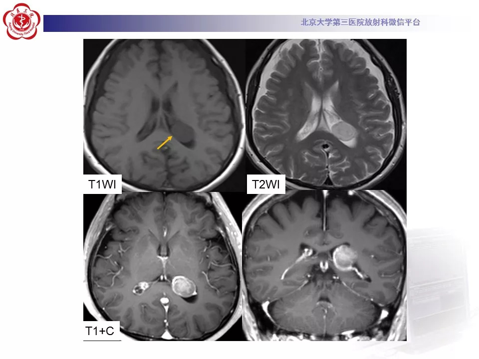 【病例】鞍区脑膜瘤1例CT及MR影像