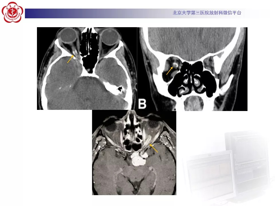 【病例】鞍区脑膜瘤1例CT及MR影像