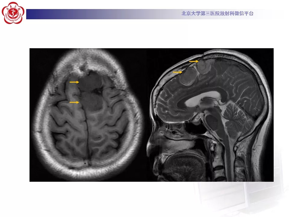 【病例】鞍区脑膜瘤1例CT及MR影像