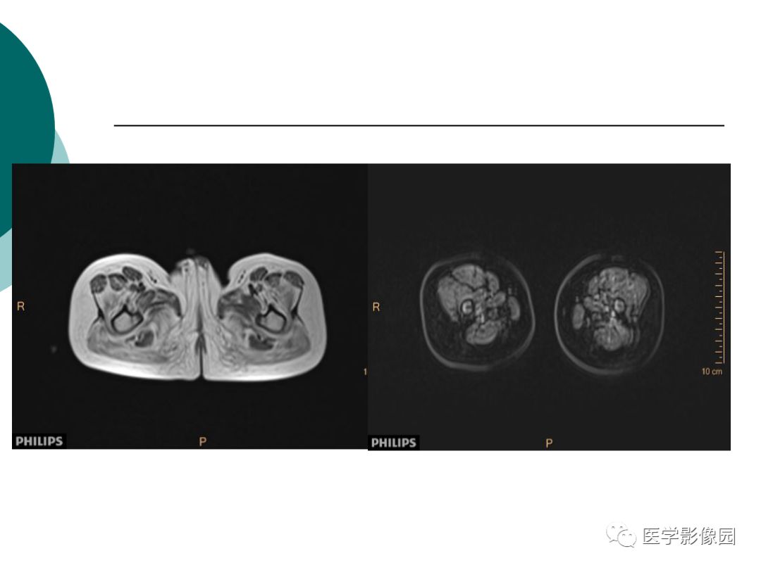 【病例】肌营养不良1例MR影像特点