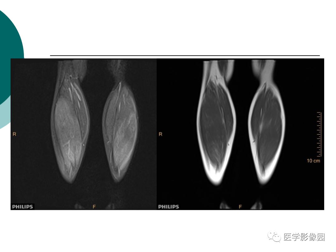 【病例】肌营养不良1例MR影像特点