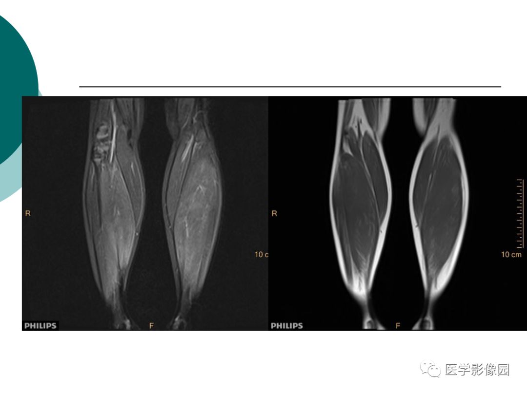【病例】肌营养不良1例MR影像特点