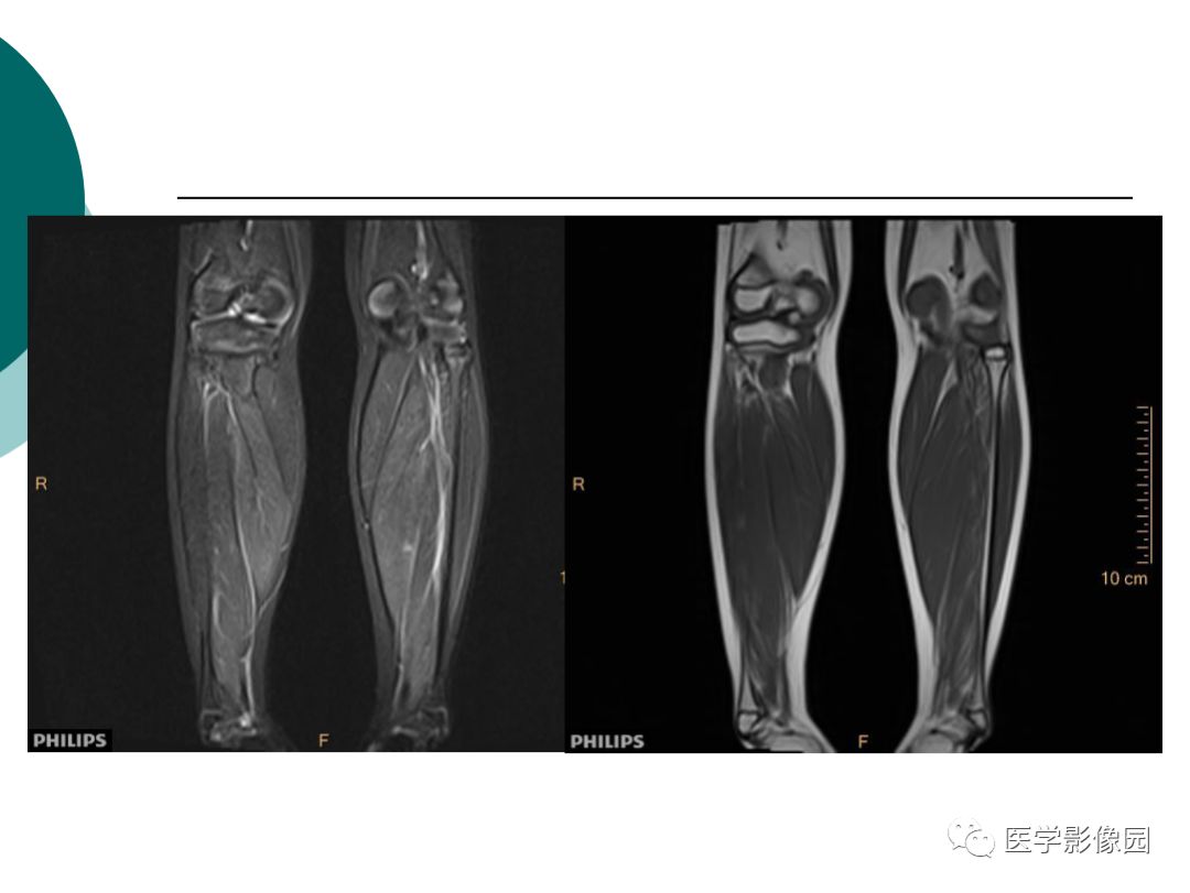 【病例】肌营养不良1例MR影像特点