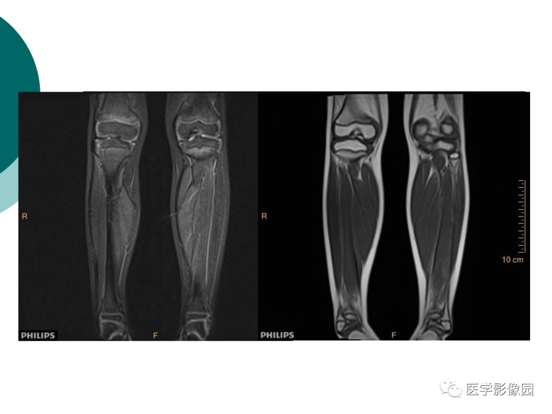 【病例】肌营养不良1例MR影像特点