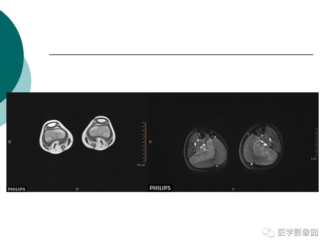 【病例】肌营养不良1例MR影像特点