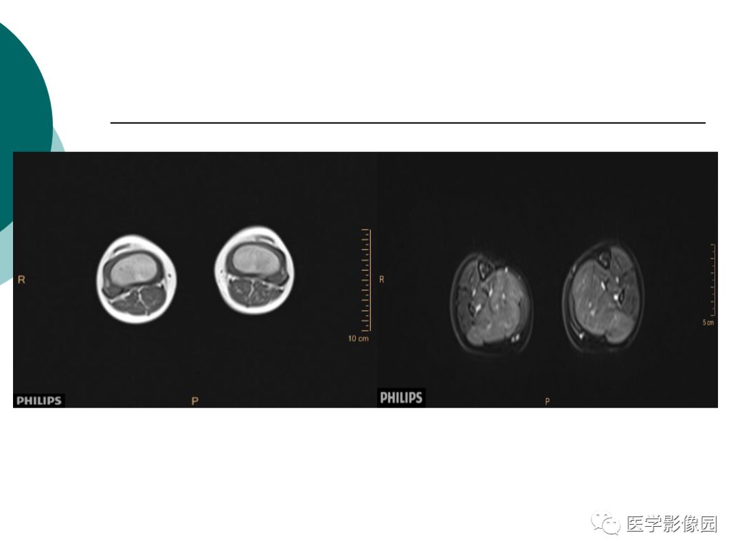 【病例】肌营养不良1例MR影像特点