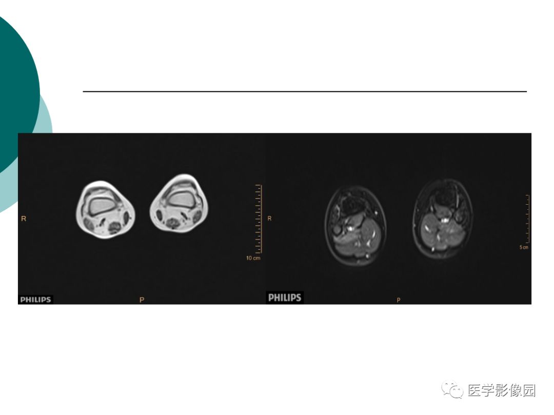【病例】肌营养不良1例MR影像特点