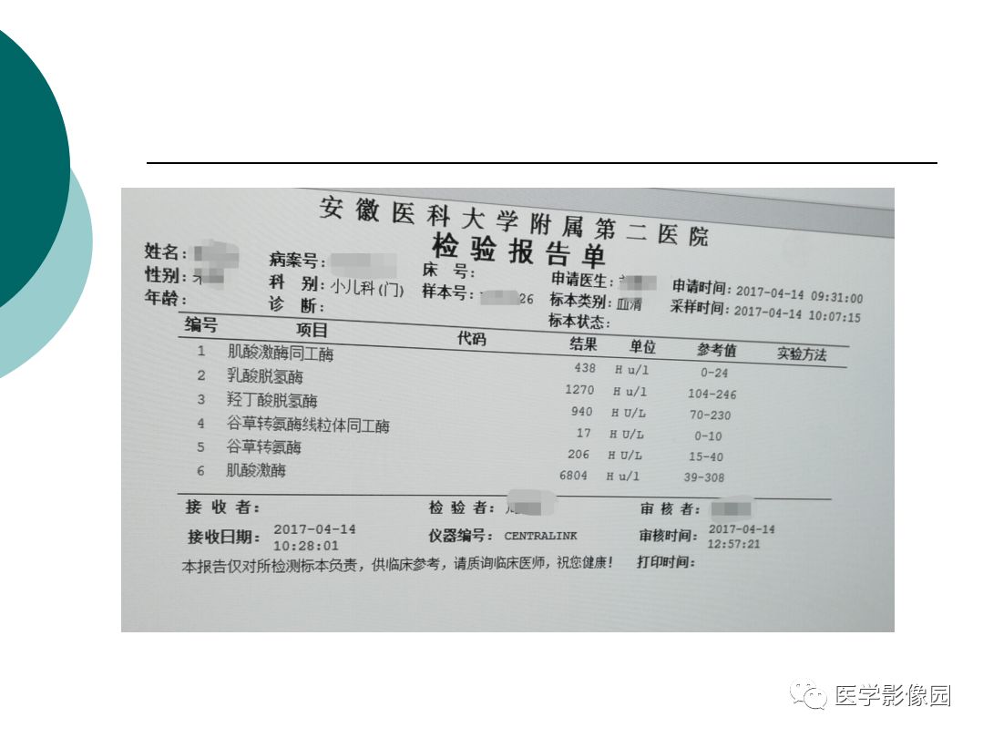 【病例】肌营养不良1例MR影像特点