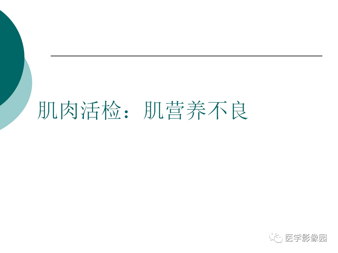 【病例】肌营养不良1例MR影像特点