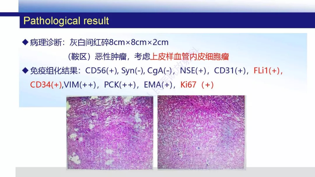【PPT】颅内上皮样血管内皮细胞瘤影像诊断