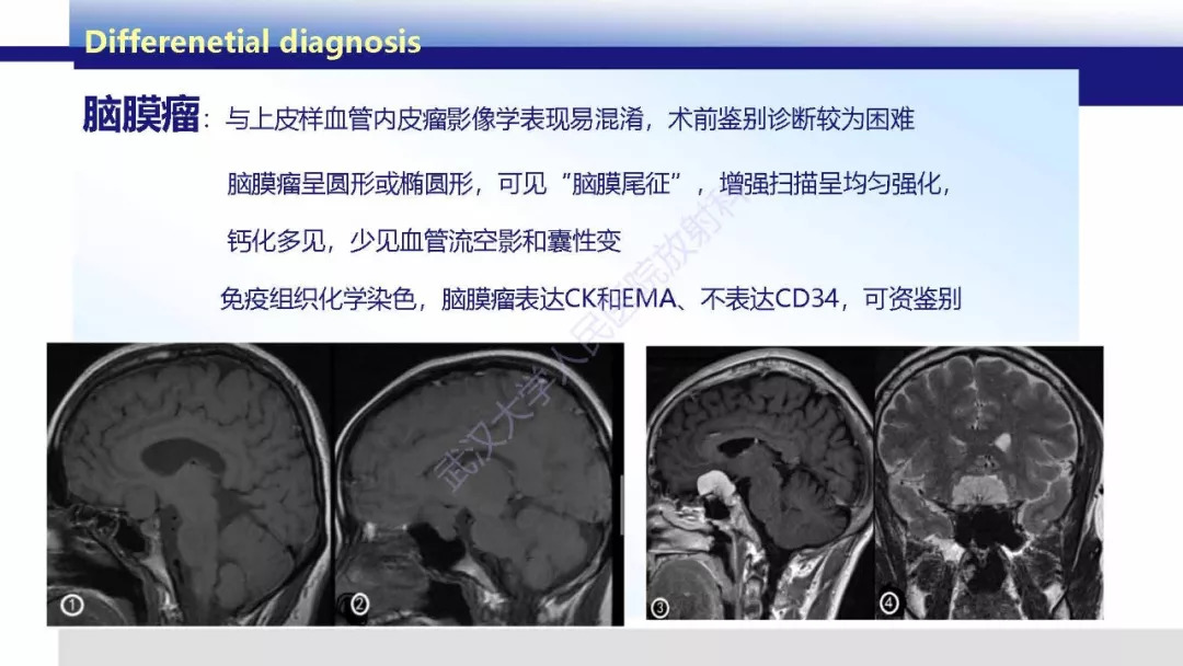 【PPT】颅内上皮样血管内皮细胞瘤影像诊断