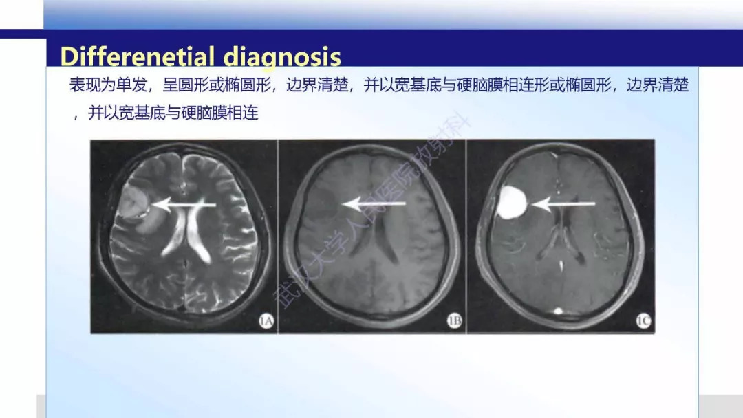 【PPT】颅内上皮样血管内皮细胞瘤影像诊断