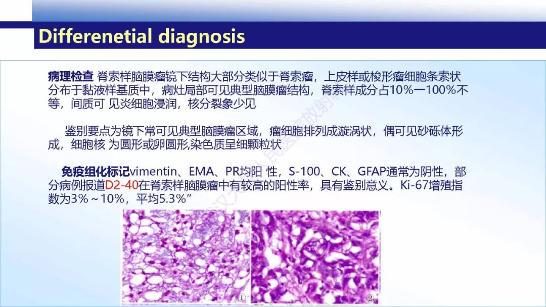 【PPT】颅内上皮样血管内皮细胞瘤影像诊断
