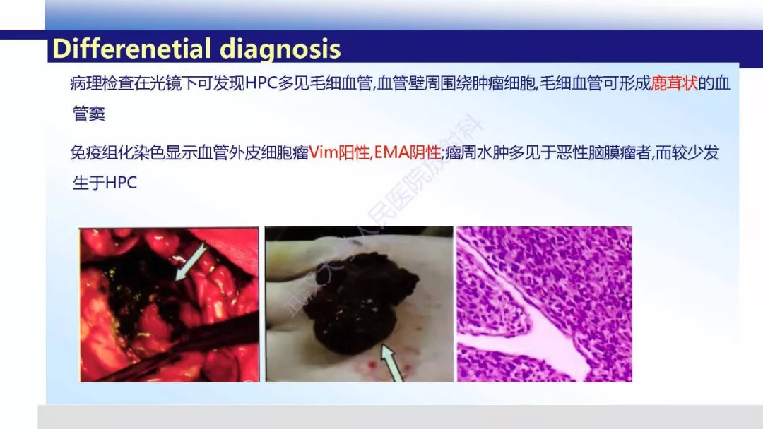【PPT】颅内上皮样血管内皮细胞瘤影像诊断