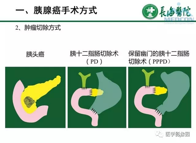 【PPT】胰胰腺癌术前影像评估及规范化报告