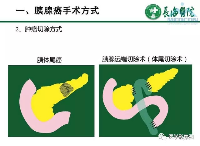 【PPT】胰胰腺癌术前影像评估及规范化报告