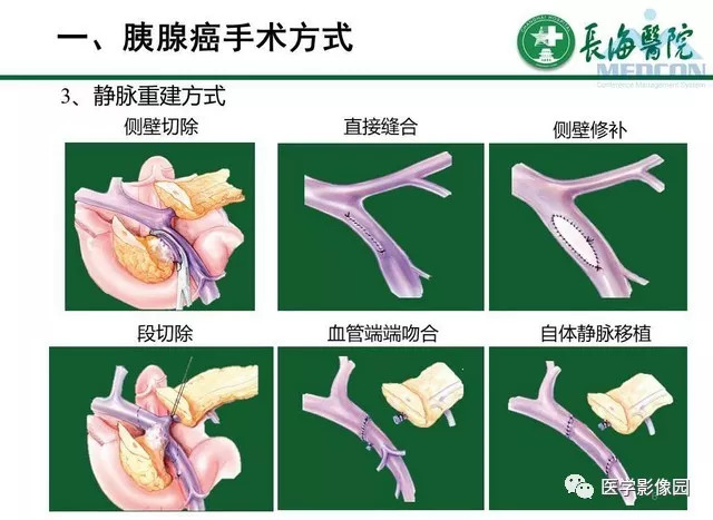 【PPT】胰胰腺癌术前影像评估及规范化报告