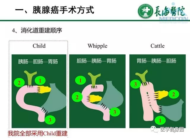 【PPT】胰胰腺癌术前影像评估及规范化报告