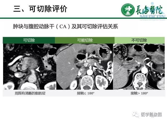 【PPT】胰胰腺癌术前影像评估及规范化报告